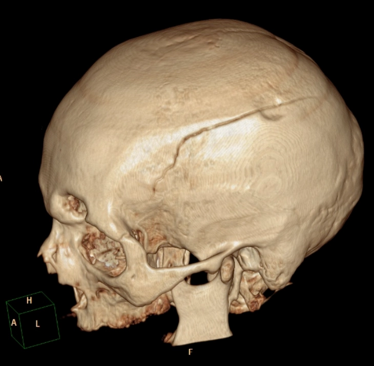 Dập não (Cerebral Contusion)