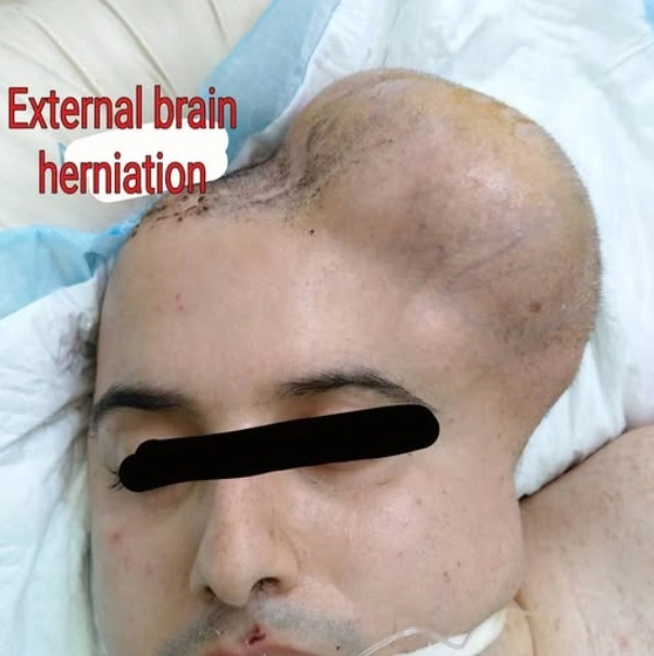 Thoát vị não ra ngoài sọ (Extracranial Brain Herniation)