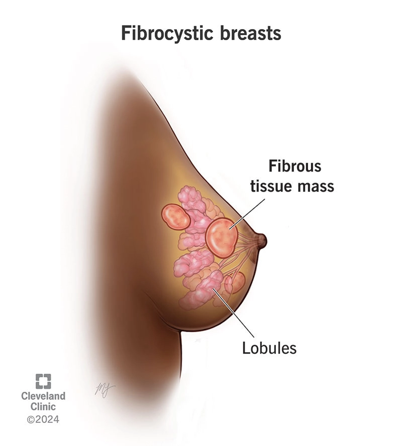 Thay đổi sợi bọc tuyến vú - Fibrocystic change (breast)