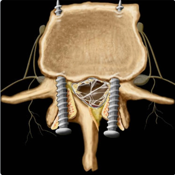 Cột sống sau phẫu thuật (Postoperative spine)