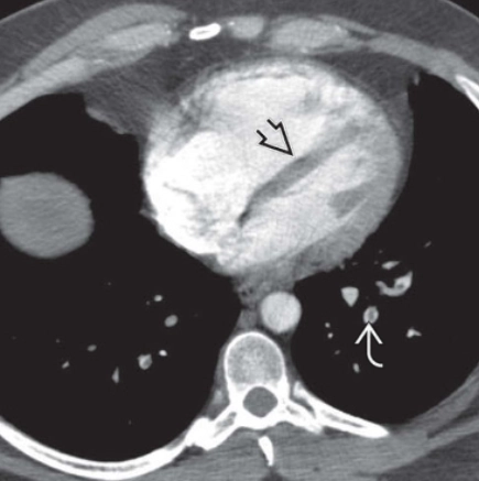 Tăng áp động mạch phổi do huyết khối mãn tính (Chronic Thromboembolic Pulmonary Hypertension - CTEPH)