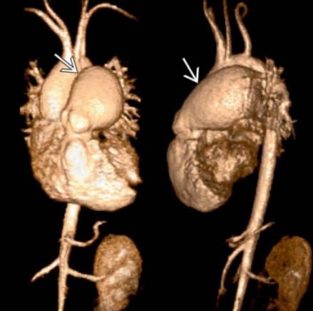 Dấu hiệu hội tụ rốn phổi (Hilum Convergence Sign) 