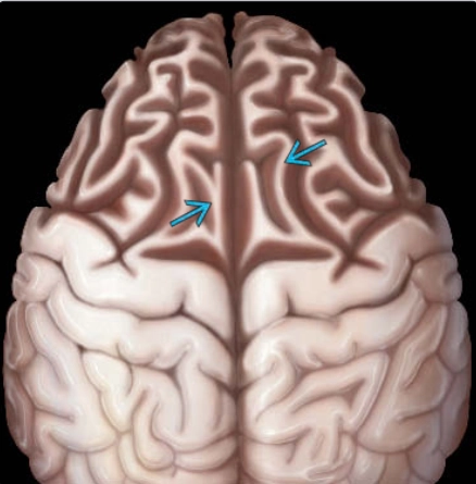 Thoái hóa thùy trán- thái dương (Frontotemporal lobar degeneration- FTLD)