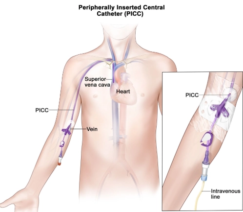 Catheter trung tâm đặt từ tĩnh mạch ngoại vi (Peripherally Inserted Central Catheter - PICC)