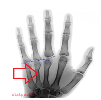 Giả suy tuyến cận giáp- Biểu hiện ở não (Pseudohypoparathyroidism)