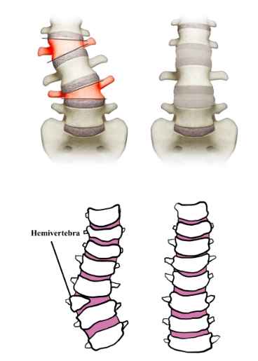 Thiếu nửa đốt sống (Hemivertebra)