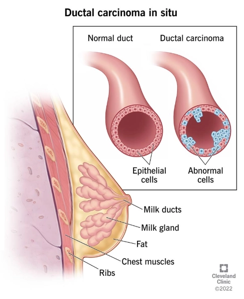 Ung thư biểu mô ống tuyến tại chỗ (Ductal carcinoma in situ)