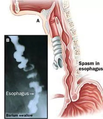 Co thắt thực quản lan tỏa (Diffuse esophageal spasm)