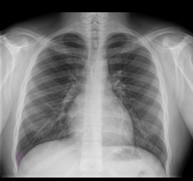 Xẹp thùy dưới phổi phải (Right lower lobe atelectasis)