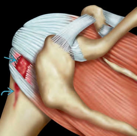 Rách chóp xoay toàn phần (Rotator Cuff Full-Thickness Tear)