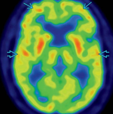 Sa sút trí tuệ thể lewy (Dementia With Lewy Bodies - DLB) 