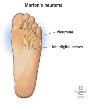 U thần kinh gian ngón (Morton neuroma)