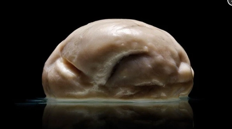 Nhẵn não thai nhi (Lissencephaly)