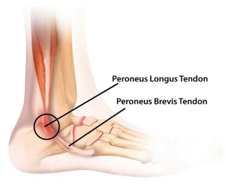 Rách gân cơ mác ngắn (Peroneus brevis tear)