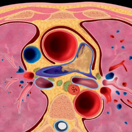 Sarcoma động mạch phổi (Pulmonary Artery Sarcoma)