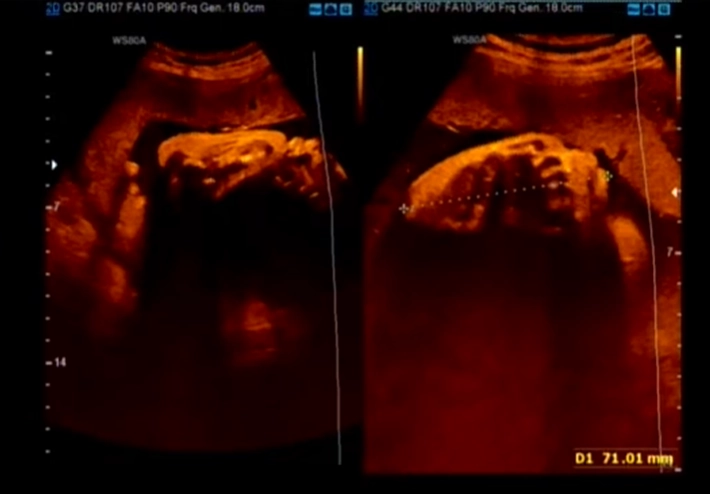 Ngắn nhẹ xương đùi / xương cánh tay thai (Mildly Short Femur / Humerus)