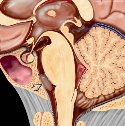 Nang thần kinh ruột (Neurenteric cysts)