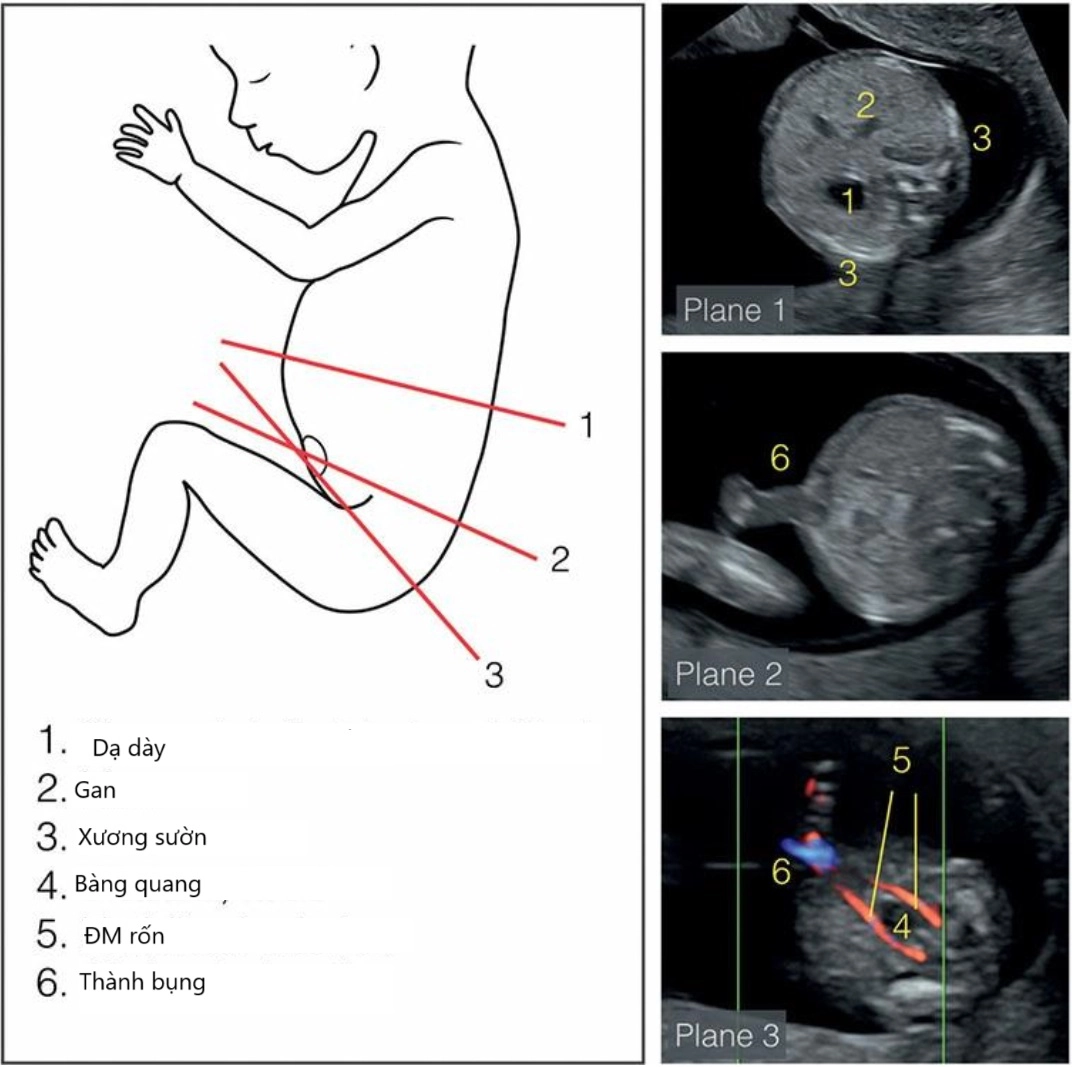 Giải phẫu siêu âm đường tiêu hóa thai quý I