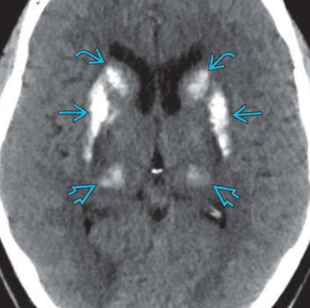 Bệnh Fahr (Fahr Disease- FD)