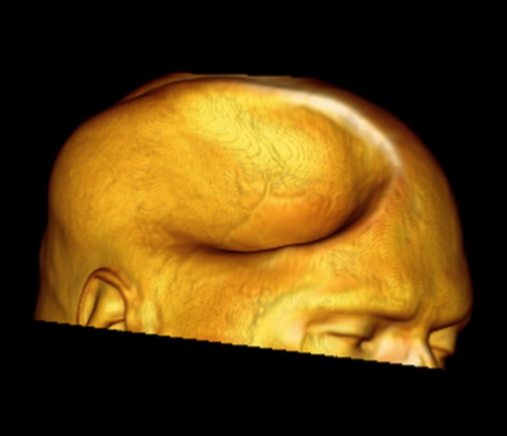 Thoát vị não nghịch thường (Paradoxical brain herniation)