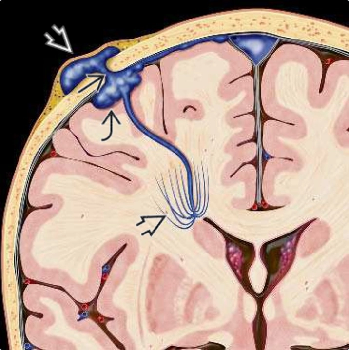 Bệnh lý tĩnh mạch não (Cerebral venous disease)