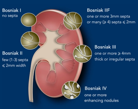 Phân loại nang thận Bosniak