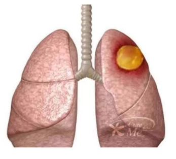 Áp xe phổi (Lung Abscess)