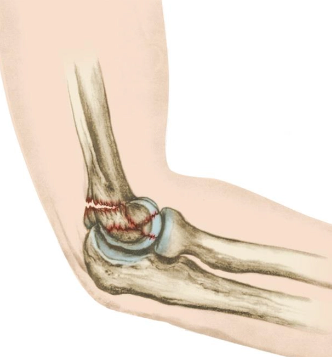 Gãy đầu dưới xương cánh tay (Distal Humerus Fracture)