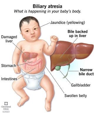 Teo đường mật (Biliary Atresia - BA)
