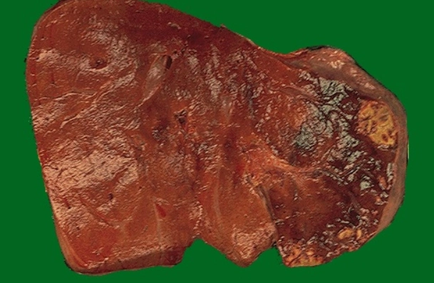 Nhồi máu gan (Hepatic infarction)