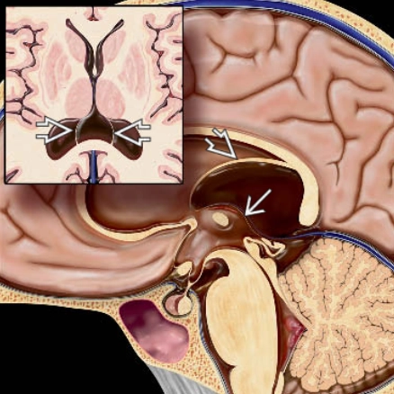 Cavum veli interpositi