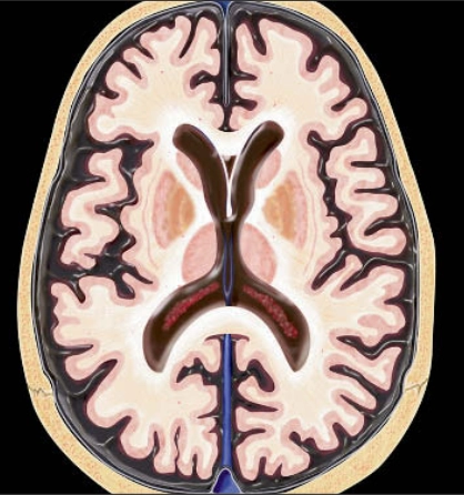 Não lão hóa bình thường (Normal Aging Brain)