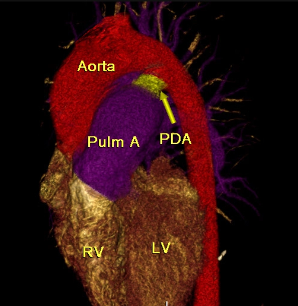 Gián đoạn đoạn gần động mạch phổi (Proximal interruption of pulmonary artery - PIPA)/Bất sản động mạch phổi một bên (Unilateral absence of pulmonary artery - UAPA)