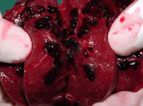 Giãn mao mạch xoang gan (Hepatic peliosis)