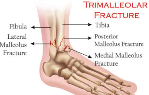 Gãy ba mắt cá chân (Trimalleolar fracture)