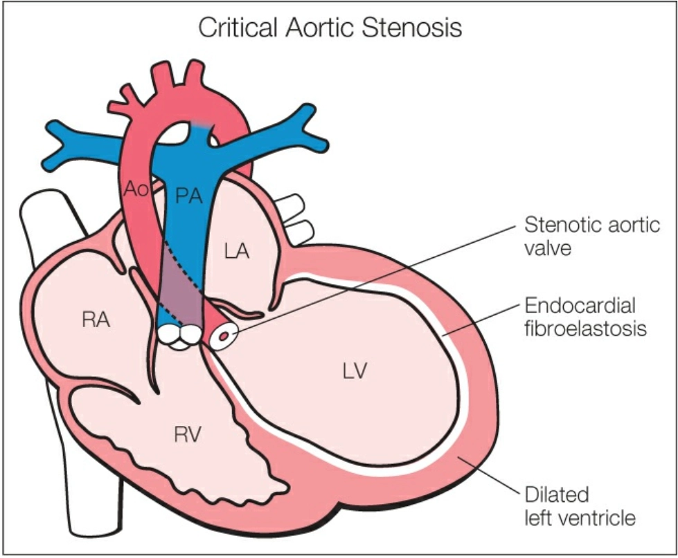 Hẹp van động mạch chủ nghiêm trọng