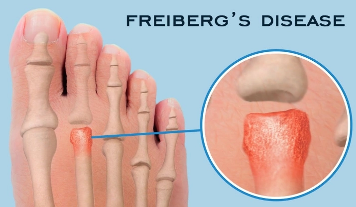 Nhồi máu Freiberg (hoại tử xương bàn chân)