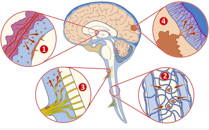 Di căn màng mềm (Leptomeningeal metastases)