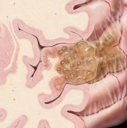 U thần kinh biểu mô loạn sản phôi (DNET) - Dysembryoplastic neuroepithelial tumors (DNET)