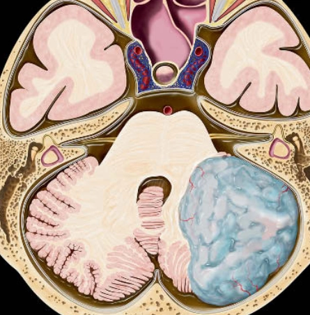 U nguyên tủy bào (Medulloblastoma)