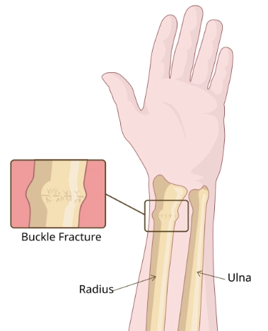  Gãy phình vỏ xương cẳng tay (Buckle fracture).