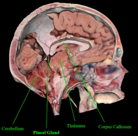 Di căn tuyến tùng (Pineal Gland Metastasis)