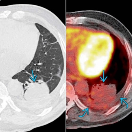 Dấu hiệu đuôi sao chổi (Comet Tail Sign)