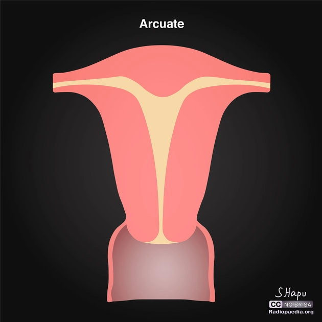 Tử cung hình cung (Arcuate uterus)