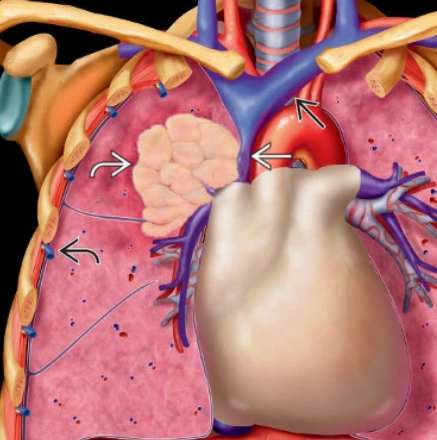 Hội chứng chèn ép tĩnh mạch chủ trên (Superior vena cava obstruction - SVCO / Superior vena cava syndrome - SVCS)