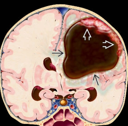 U hạch thần kinh đệm/u sao bào tạo mô đệm tân sản ở trẻ nhũ nhi (Desmoplastic Infantile Ganglioglioma/Astrocytoma)