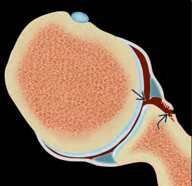 Tổn thương Bankart (Bankart Lesion)/ Rách sụn viền trước dưới