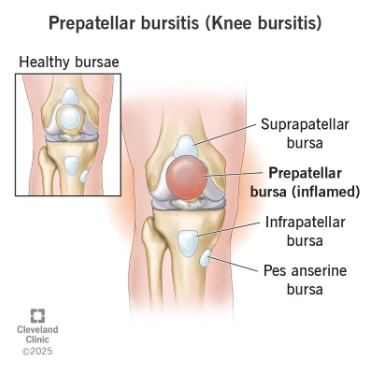 Viêm bao hoạt dịch trước bánh chè (Prepatellar bursitis)