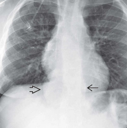 Tạo máu ngoài tủy (biểu hiện ở ngực)(Extramedullary Hematopoiesis)