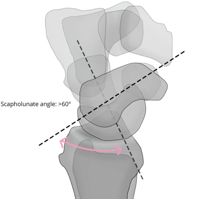 Mất vững về phía mu tay từng đoạn (Dorsal Intercalated Segment Instability - DISI)